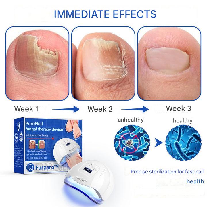 ClearZap+™ Fungal Light Therapy Device | A quick, effective and painless solution!