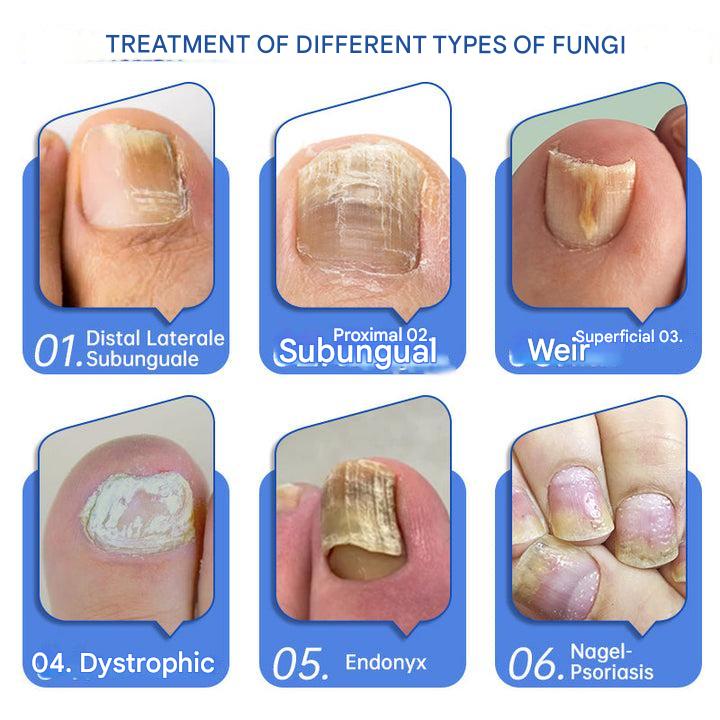 ClearZap+™ Fungal Light Therapy Device | A quick, effective and painless solution!