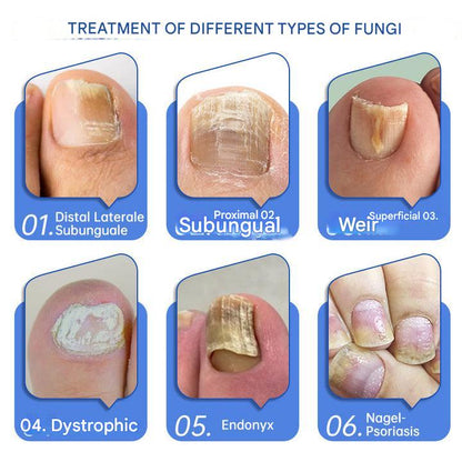 ClearZap+™ Fungal Light Therapy Device | A quick, effective and painless solution!