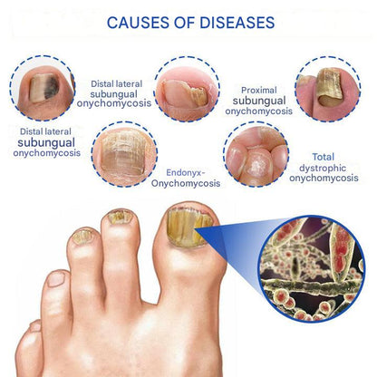 ClearZap+™ Fungal Light Therapy Device | A quick, effective and painless solution!