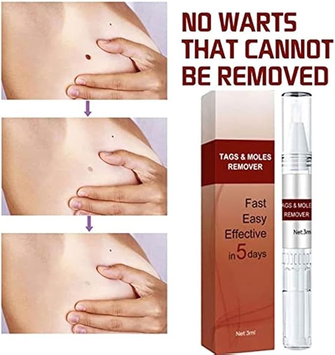 ZapWipe™ Freckle and mole remover