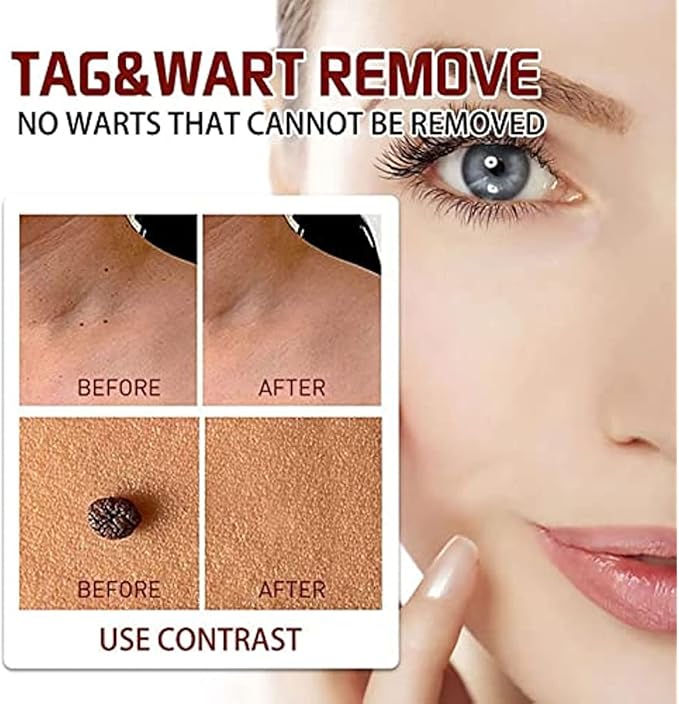 ZapWipe™ Freckle and mole remover